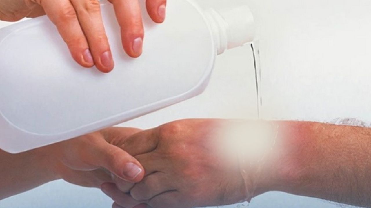 Algunas quemaduras con ácido se agravan si se enjuagan con agua