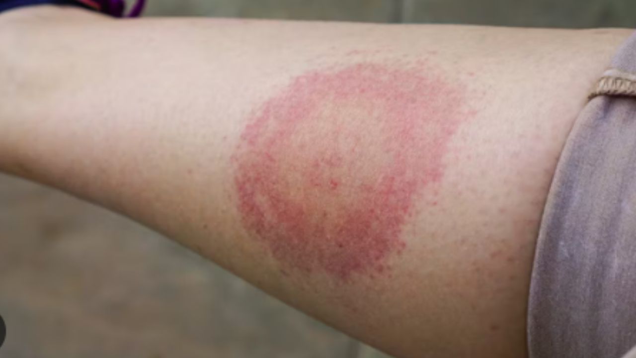 La enfermedad de Lyme es una infección bacteriana que se contrae por la picadura de una garrapata