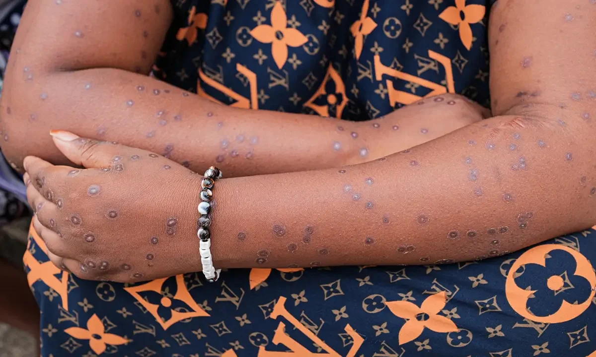 alerta por la epidemia de mpox