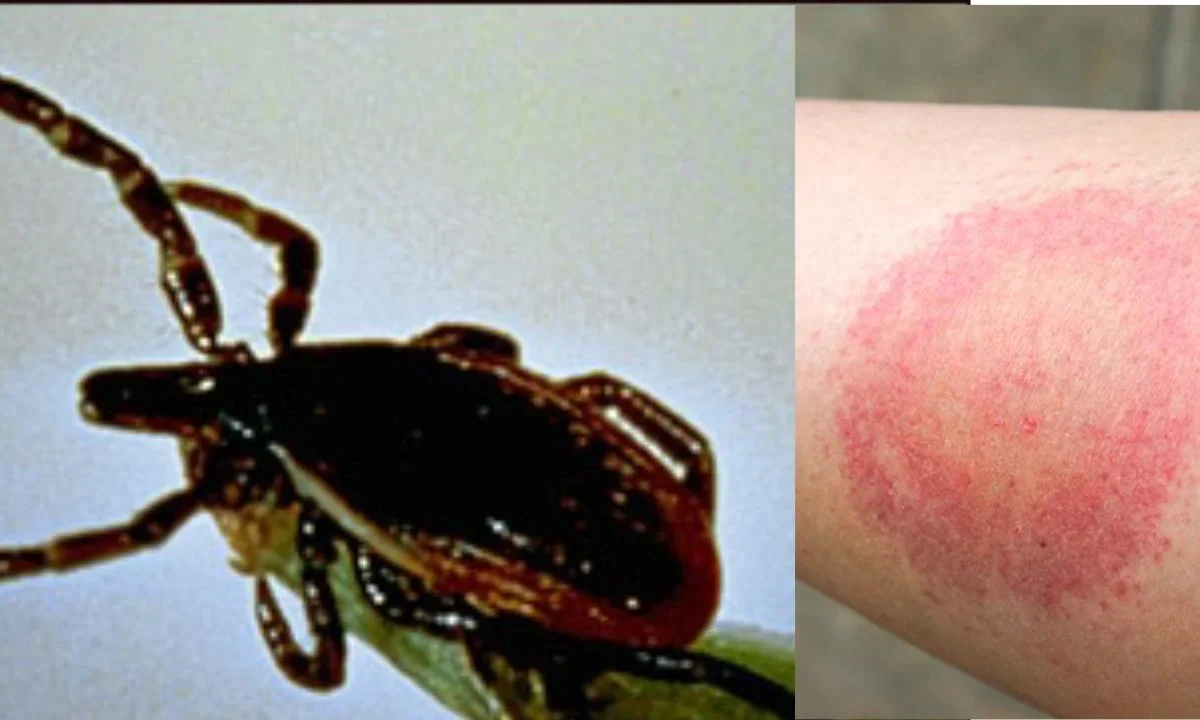 ¿Cómo prevenir la enfermedad de Lyme? Checa estas recomendaciones
